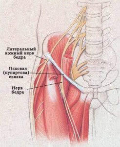 Неврит бедренного нерва